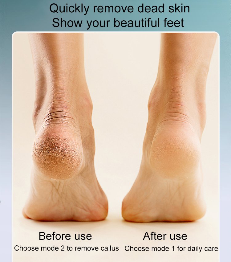 🎁Hot Sale 49 % RABATT🔥Wiederaufladbarer elektrischer Hornhautentferner für den Fuß